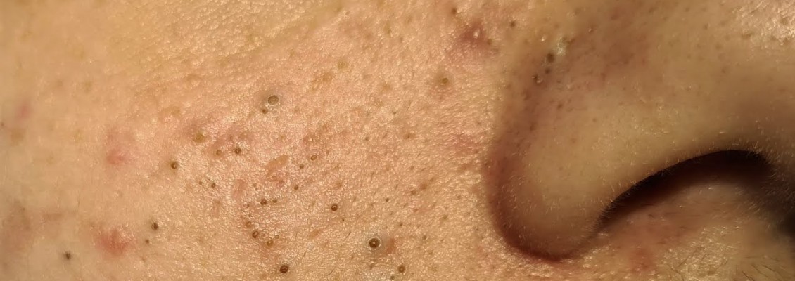 ACNE SKIN ACNE SKIN