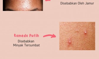 Timoti Tip : How to Overcome Pimple